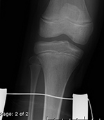 Traction pin